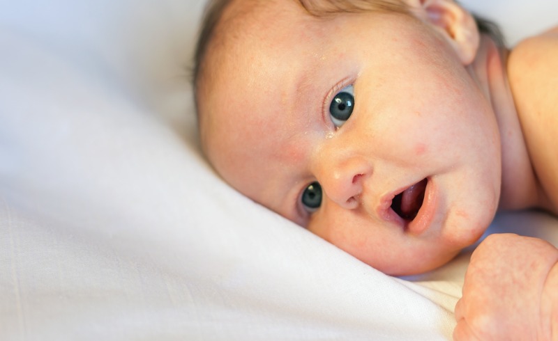Bebek Aknesi (Sivilcesi): Nedir, Neden Olur, Belirtileri ve Tedavisi