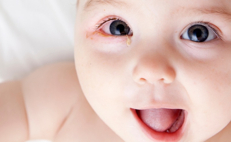 Bebeklerde Göz İltihabı Belirtileri ve Tedavisi