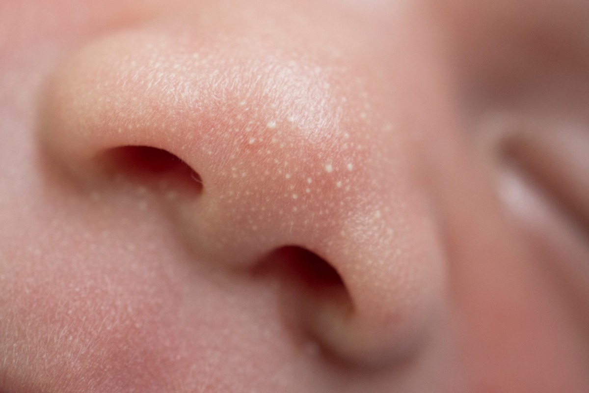 How to Identify Milia from Other Skin Conditions in Infants